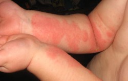Eczema and Skin Rashes