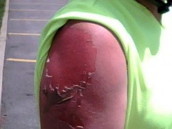 sunburn remedies