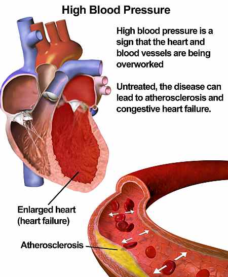 What is High Blood Pressure