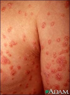 Psoriasis Speaks