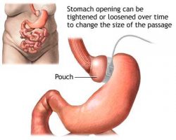 Gastric Bypass Risks