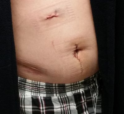 bloated scars - post Kidney Donation