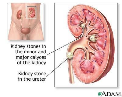 natural remedy for kidney stones