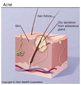Treating Acne for Teenagers