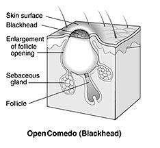 How To Get Rid of Blackheads