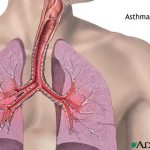 asthma remedy