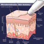 microderm abrasion