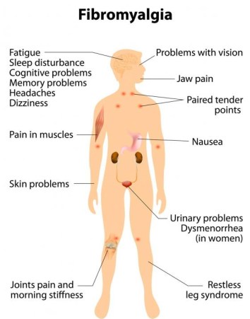 symptoms-of-fibromyalgia