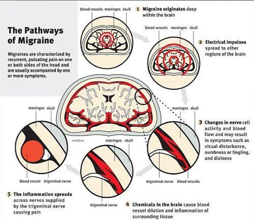 migraine pathways