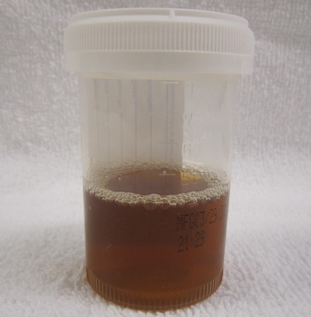 Brown colored urine from Rhabdomyolysis