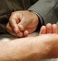 Acupuncture as Alternative Therapy